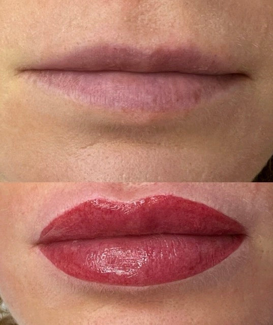 Résultat final Candy Lips à Tours après cicatrisation