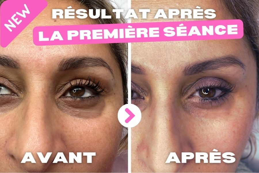 Traitement des Cernes à Tours